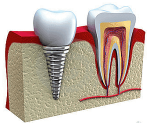 Dental implant illustration showing post, abutment and crown at Soltanik Dental in Aventura FL
