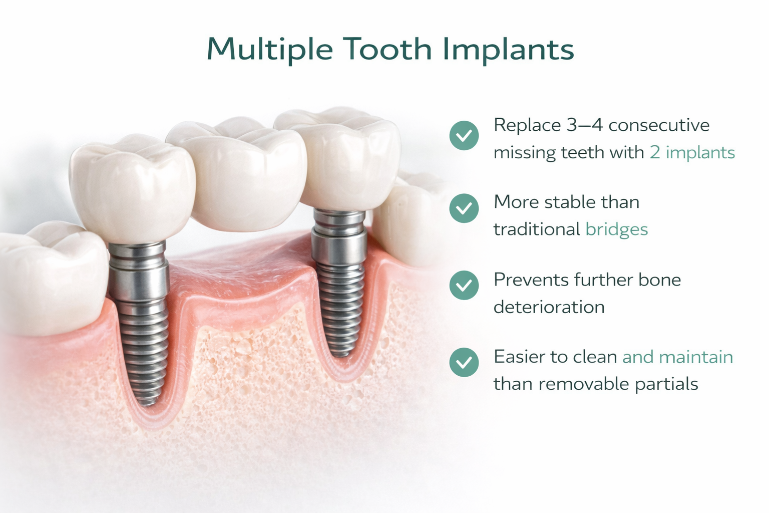 Multiple Tooth Dental Implants - Bridge Solution Aventura FL