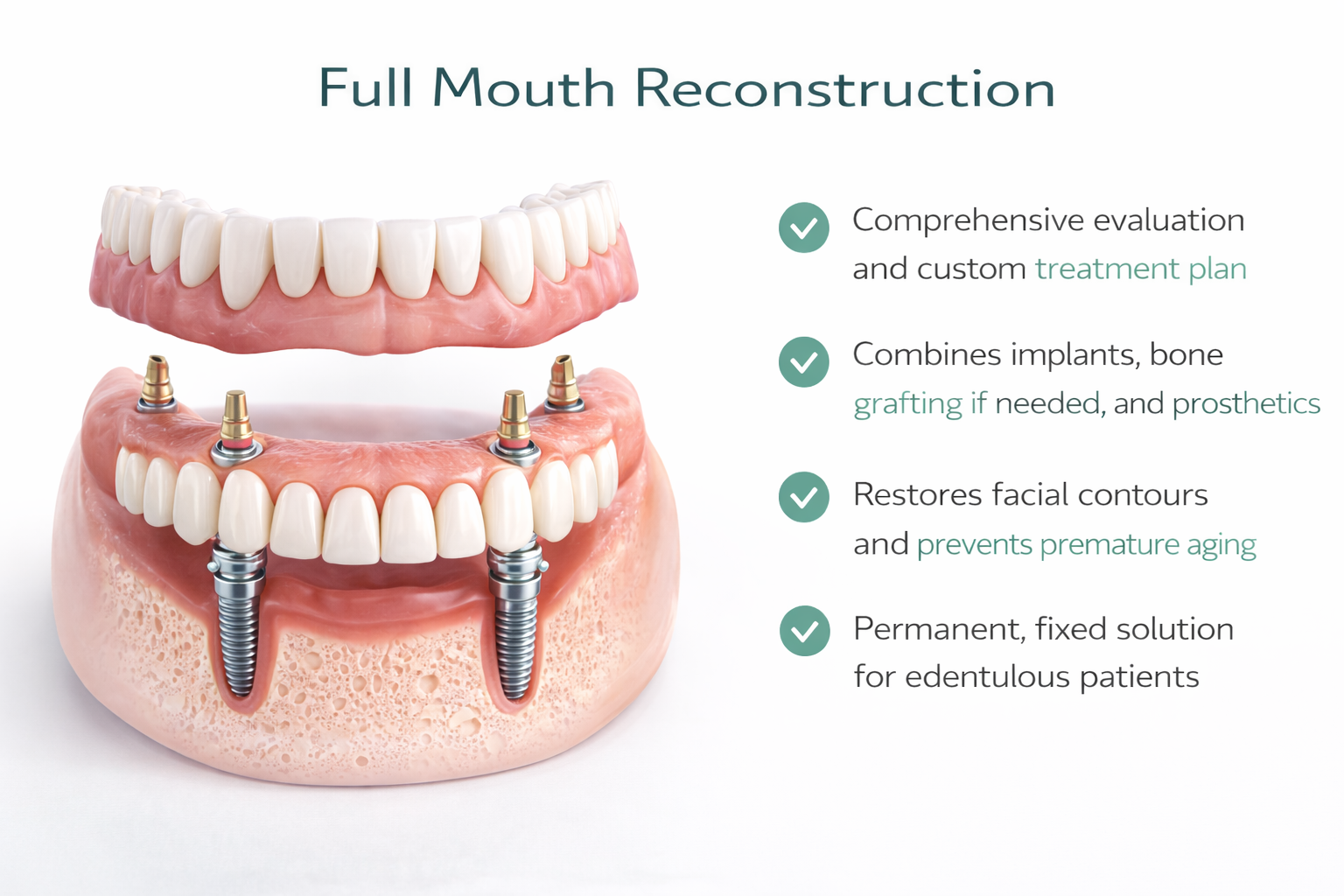 Full Mouth Reconstruction with Dental Implants Miami