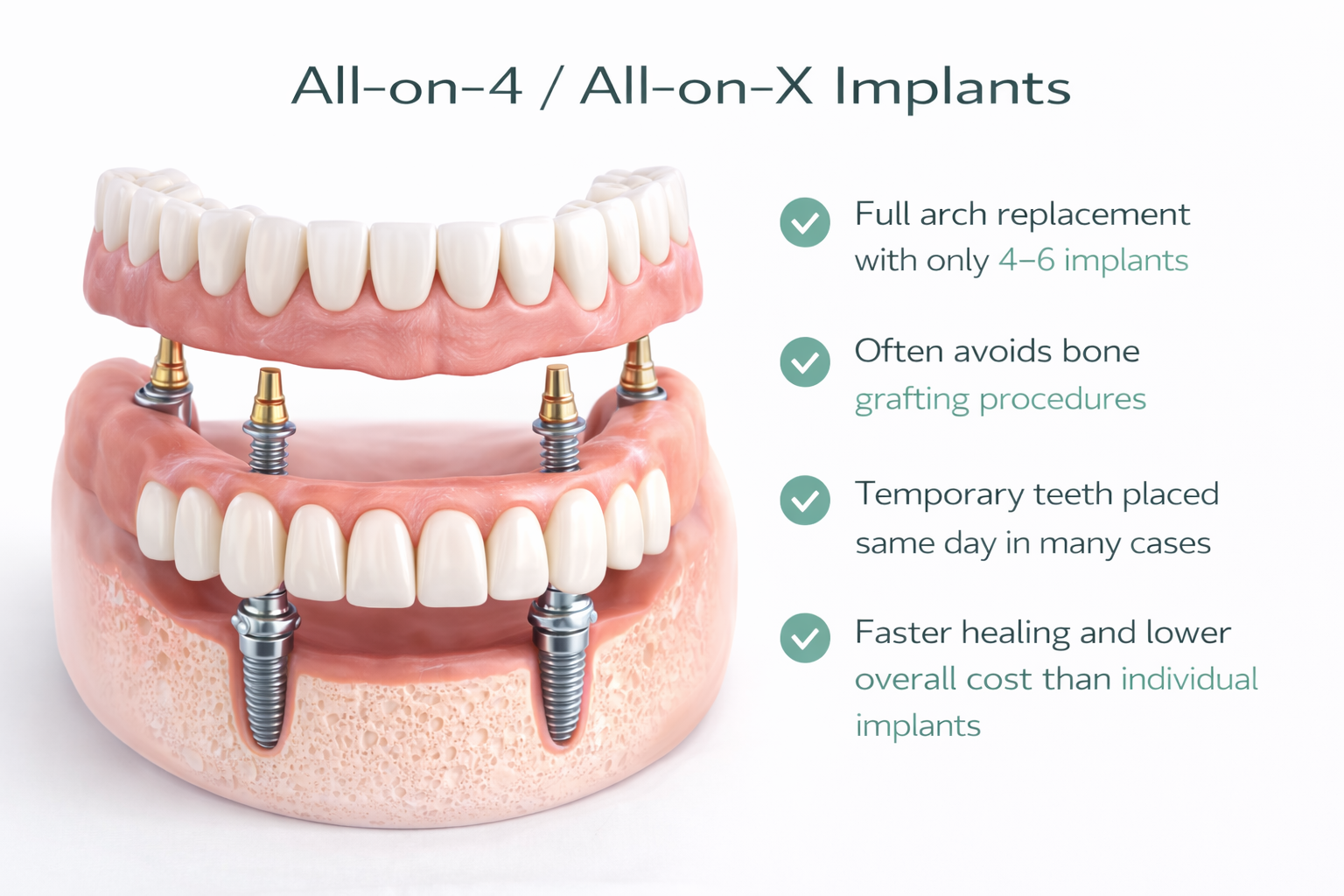 All-on-4 Dental Implants Full Arch Replacement Aventura