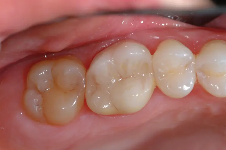 Patient tooth after dental crown restoration