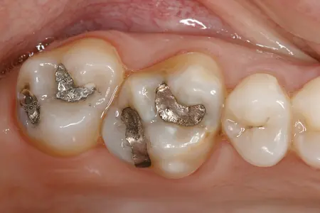 Patient tooth before ceramic inlay treatment