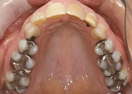 Patient teeth before multi-tooth restorative treatment