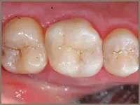 Patient tooth after ceramic onlay treatment