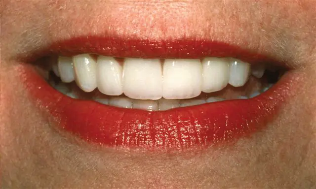 Patient smile after porcelain veneer treatment