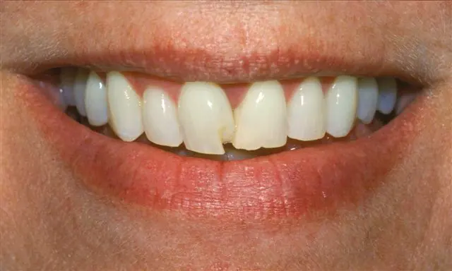 Patient smile before porcelain veneer treatment